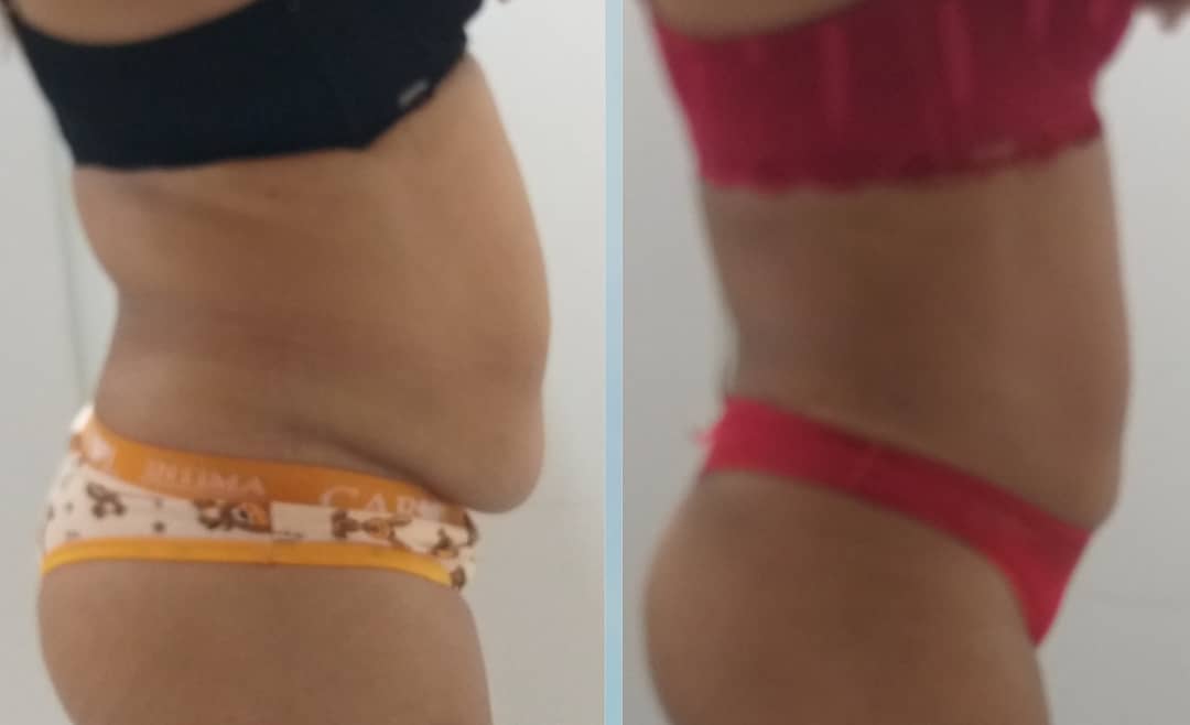 Evolução do tratamento de crio - Foto 8